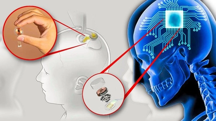 Neuralink’in Üçüncü Beyin Çipi Operasyonu Başarıyla Tamamlandı